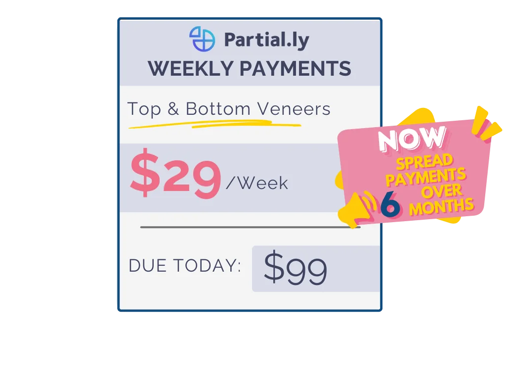 Weekly Payment Plan - Pop On Veneers with At Home Impression Kit